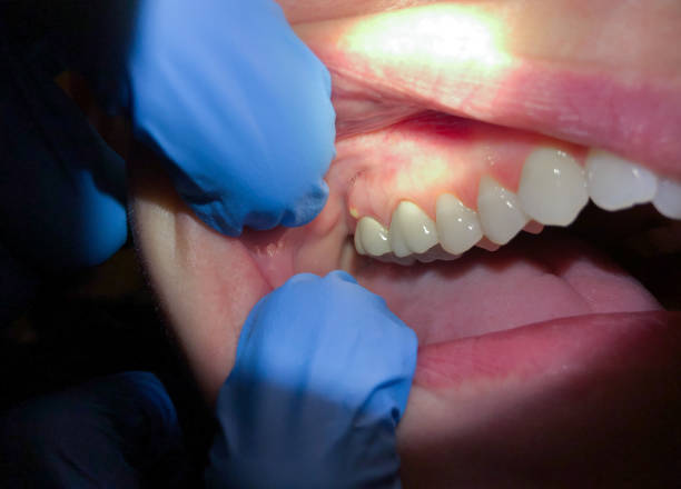 Best Emergency Tooth Extraction in Waukomis, OK